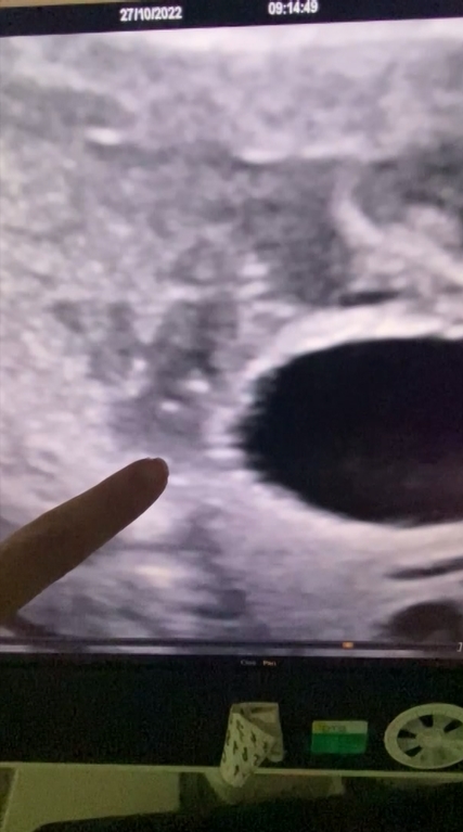 İdrar yolunda darlık tespit edilen bebeğe stent takıldı